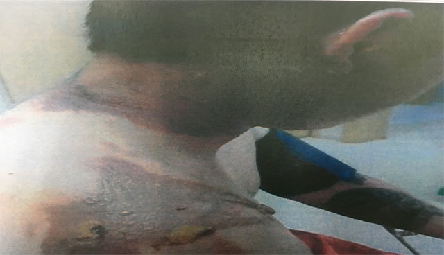 보이스피싱 단체에서 탈출하려다 붙잡힌 조직원의 모습. 다른 조직원들이 끓인 물을 부어 심한 화상을 입었다. 서울지방경찰청 제공