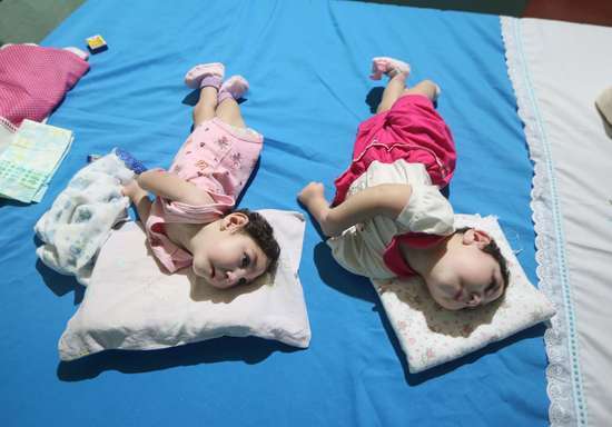 지카바이러스에 감염돼 소두증에 걸린 신생아. © News1 (자료사진)