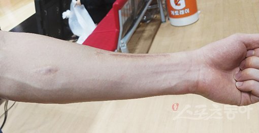 흉터투성이인 그의 왼팔은 피나는 노력을 보여주는 한 단면이다. 정지욱 기자 stop@donga.com