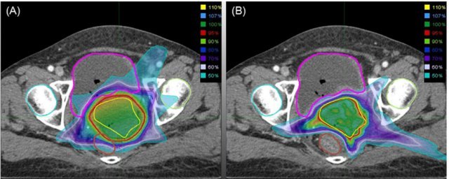 기존에 시행했던 3차원 입체 조형치료(3D CRT, 3dimensional conformal radiotherapy)와 세기 조절 방사선치료(IMRT)를 비교한 결과(왼쪽부터) IMRT가 자궁경부암 부위에 더 효과적으로 조사됐다. © News1