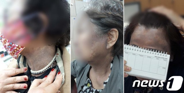 헤나 방 염색 이후 피해자 모습들 © News1