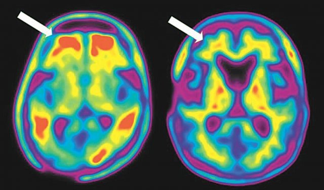 아밀로이드 PET영상. 왼쪽처럼 알츠하이머 치매 환자에서는 뇌피질 부위에 아밀로이드 침착으로 붉은 색깔(화살표)로 보이게 된다. 정상인은 뇌피질 부위에 아밀로이드 침착이 없음을 볼 수 있다(오른쪽).