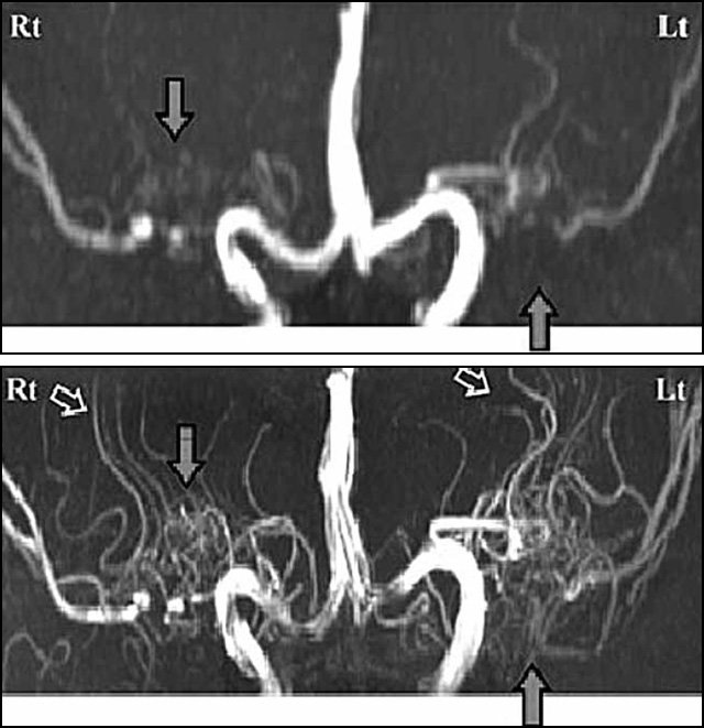 3T와 7T MRI 비교 사진 3T MRI(위)에선 보이지 않던 미세한 혈관(화살표)이 7T MRI에서는 자세히 보인다. 길병원 제공