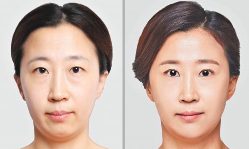 비절개 상안검 수술 전과 후 모습.