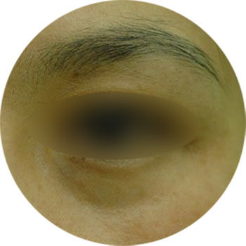 눈 밑 지방과 색소 침착 등의 복합 원인으로 다크서클이 생긴 여성의 왼쪽 눈 부위. 다크서클은 원인을 정확히 진단해 원인별 맞춤형 치료를 해야 한다. 동아일보DB