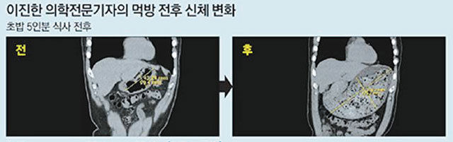 먹방에 도전한 이진한 기자의 먹방 전후 위 사진. 초밥 5인분을 먹은 뒤 컴퓨터단층촬영(CT)을 해보니 위의 부피가 먹기 전보다 30배가량 커졌다.