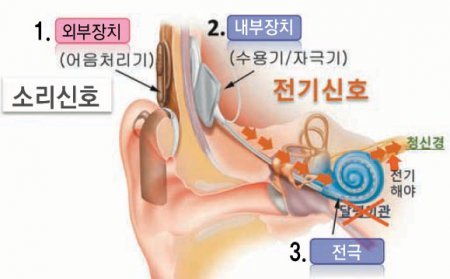 인공와우 수술이란 인공와우는 외부 소리를 받아들여(1) 이를 전기 신호로 바꾼 뒤(2) 청각신경으로 전달하는(3) 장치이다.