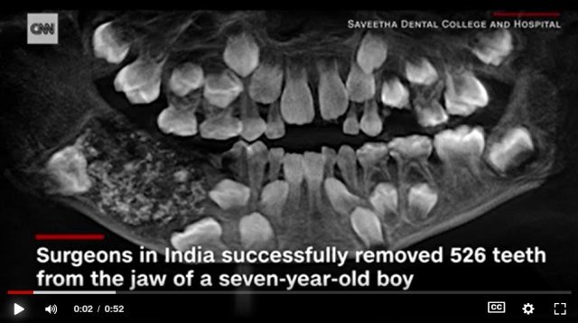 인도 7세 소년의 입 속 엑스레이 사진 © CNN화면 캡처