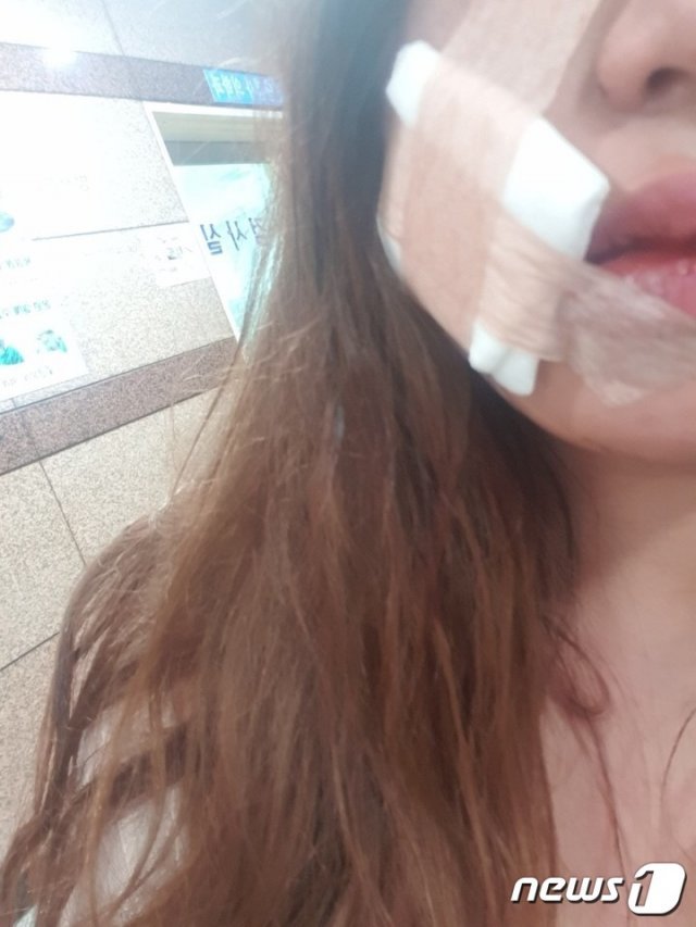 지난 9일 새벽 남양주시내 데이트 폭력 피해자가 안면에 부상을 입고 20여 바늘을 꿰매는 치료를 받았다고 밝혔다. © 뉴스1