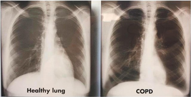 건강한 폐(왼쪽)와 COPD 환자의 폐(오른쪽). 원 안의 사진은 COPD 환자의 폐포.