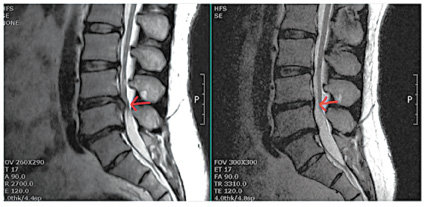 하이브리드 고주파 디스크 치료술 전(왼쪽)과 후 병변 부위 MRI 변화.