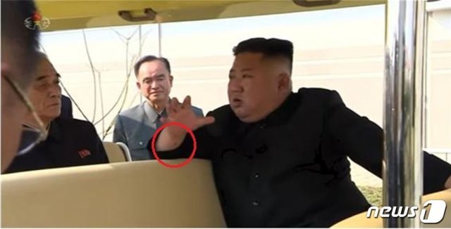 김정은 북한 국무위원장의 팔에 있는 검은 자국을 두고 심장관련 시술 가능성이 제기되고 있다. (조선중앙TV 갈무리)