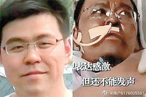 건강했던 시절 후웨이펑 씨의 모습(왼쪽 사진)과 신종 코로나바이러스 감염증 집중 치료 과정에서 얼굴색이 검게 변한 모습. 베이징TV 화면 캡처