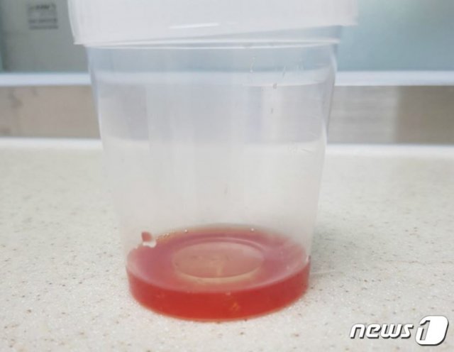 햄버거병으로 투석치료를 받고 있는 안산 유치원생 몸에서 배출된 혈뇨.(인터넷 커뮤니티 캡처) © 뉴스1