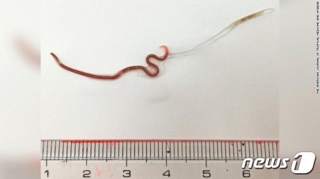 일본 여성의 편도에서 나온 회충. 길이가 3.8㎝에 이른다. © 뉴스1