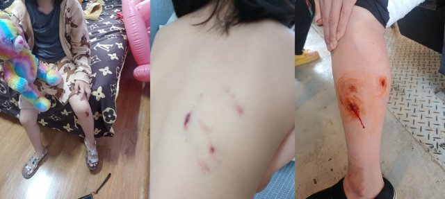 목줄없는 개들한테 다리와 등을 물린 피해아동(사진 왼쪽, 가운데)과 다리를 물린 40대 여성(사진 오른쪽) © 뉴스1