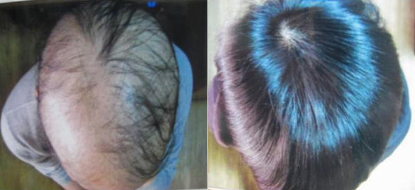 한 환자의 탈모치료 전, 후 모습. 백명기 원장 제공.