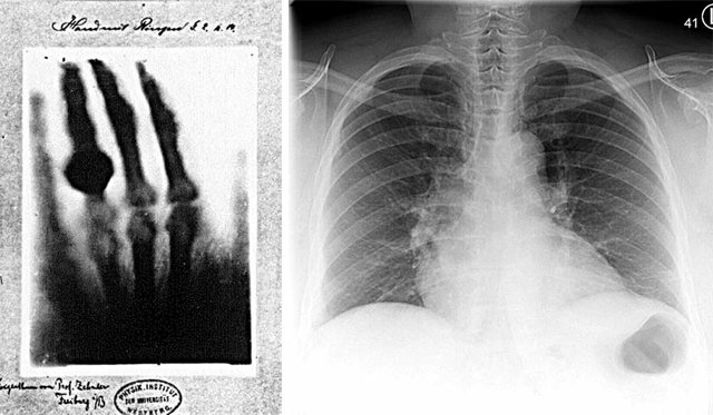 독일의 물리학자 빌헬름 뢴트겐이 촬영한 최초의 인간 X선 사진(왼쪽 사진). 코로나19 환자가 폐 질환을 겪을 때 전형적으로 나타나는 간유리음영 현상이다. 폐에 반투명 유리 같은 옅은 음영이 곳곳에서 나타난다. 위키피디아 제공