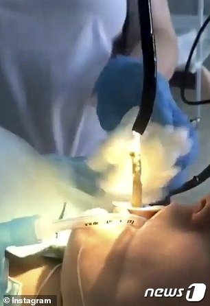 의료진이 내시경을 이용해 여성의 입에서 알 수없는 물질을 끄집어 내고 있다. (인스타그램)© 뉴스1