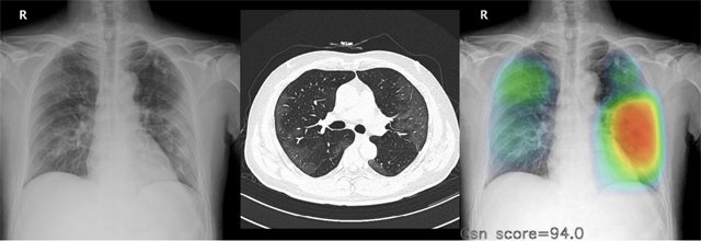왼쪽 사진부터 코로나19 확진 판정을 받은 환자의 흉부 엑스레이 영상과 컴퓨터단층촬영(CT) 영상, 그리고 인공지능(AI)의 분석
 영상. 루닛 인사이트 CXR는 AI가 환자의 흉부 엑스레이 사진을 수초 내로 분석해 각 질환의 의심 부위와 의심 정도를 자동 
표기한다. 환자의 양쪽 폐에 존재하는 병변을 정확하게 나타내고 있다. 루닛 제공