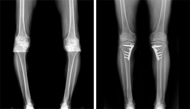 휜 다리도 줄기세포 치료로 고칠 수 있다. 60대 후반 여성의 휜 다리(왼쪽 사진)가 반듯하게 펴졌다. 강남제이에스병원 제공