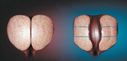 유로리프트(전립선결찰술) 시술 전(왼쪽) 전립선과 시술 후 전립선.
