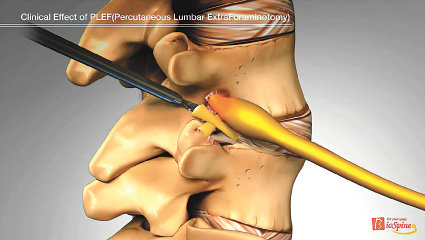 한미일 특허받은 키트를 ‘추간공 접근법’을 통해 추간공 ‘후방부 경막외강(등쪽 공간)’을 타킷으로 접근해 추간공확장술을 진행하는 모습. 서울광혜병원 제공