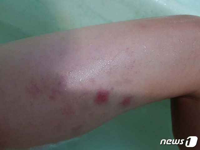 A군의 허벅지에 멍이 든 모습.(A군 아버지 제공)2020.10.14 /© 뉴스1