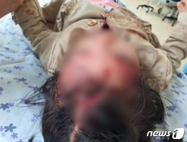 지난 4월 강진 가우도 집트랙을 이용하던 4살 여자 아이가 머리가 찢어지는 중상을 입었다.(강진군 홈페이지에 올라온 사진) /© 뉴스1