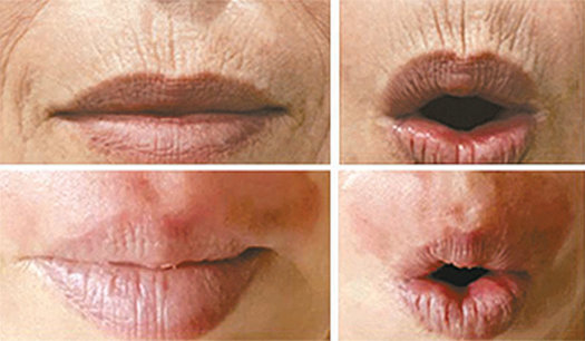 고양이 주름 피부박피 시술 전(위쪽 사진)과 아래쪽은 시술 후 사진.