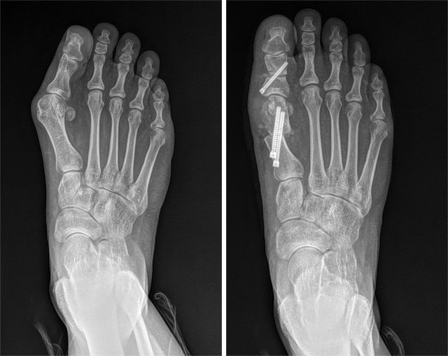 최소침습 무지외반증 수술 전(왼쪽)과 후의 발 X선 사진. SNU서울병원 제공