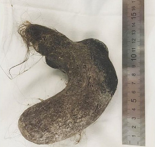 소녀의 뱃속에서 의료진이 꺼낸 머리카락 뭉치의 모습. (울란우데 아동병원 인스타그램 갈무리) © 뉴스1