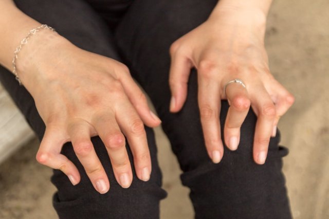 류마티스 관절염으로 관절에 변형이 생긴 여성의 손. [셔터스톡]