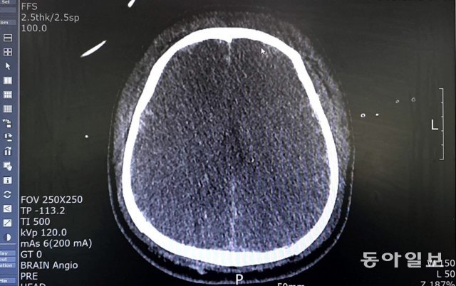손현승 씨의 뇌 컴퓨터단층촬영(CT) 사진. 평범한 뇌 사진에서 보이는 뇌실과 주름이 전혀 보이지 않고 까맣게 변해있다.
