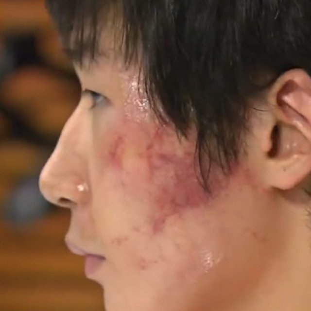 2009년 9월 폭행당한 뒤 기자회견에 나선 박철우의 얼굴에 상처가 그대로 드러나 있다. KBS뉴스 캡처
