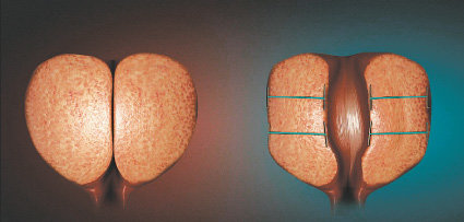 비대해져 요도를 막고 있는 전립샘(왼쪽), 유로리프트를 진행해 비대해진 전립샘을 묶어 확장된 요도.