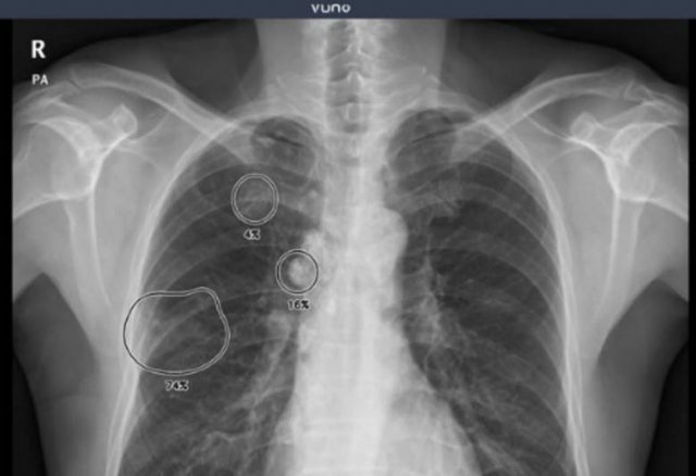 의료 스타트업 '뷰노'의 X-레이 인공지능 판독 (출처=뷰노 홈페이지)