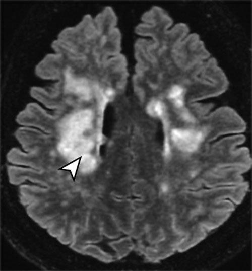 코로나19 완치 후 섬망을 겪던 환자의 뇌를 자기공명영상(MRI) 장치로 촬영한 모습. 미세 출혈이 발생한 곳이 화살표로 표시돼 있다. 프랑스 파리뇌연구소 연구팀 제공