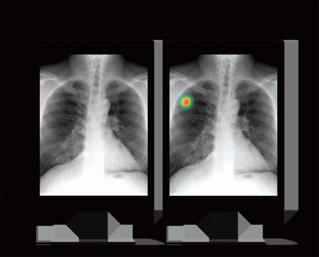 루닛이 개발한 ‘루닛 인사이트 CXR’를 활용해 병변을 진단한 엑스레이(X-ray) 결과물. 오른쪽과 같이 엑스레이상에 병변이 색깔로 구별돼 판독하기 편리하다. 루닛 제공