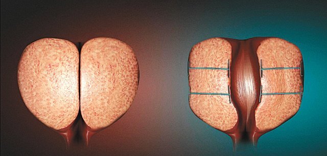 유로리프트는 요도에 내시경과 특수 금속 실(결찰사)을 넣은 다음 비대해진 전립샘을 묶어 요도 압박을 풀어주는 방식의 치료법이다. 시술 전(왼쪽), 시술 후 사진.