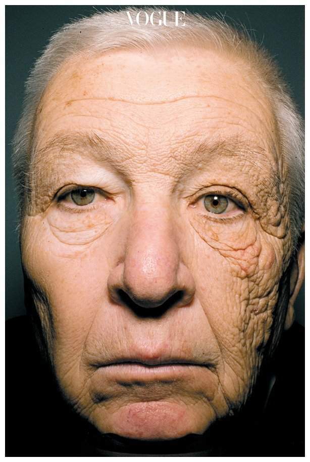 한 쪽 얼굴에만 햇빛을 받는 생활을 수십 년 간 해온 트럭 운전수의 얼굴. 햇빛이 피부노화에 어떤 영향을 미치는지 알려주는 사례로 자주 거론된다.