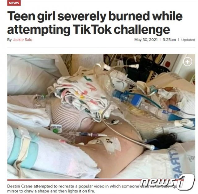 미국 오리건주에 사는 데스티니 크레인(13)이 틱톡 챌린지를 하다 3도 화상을 입고 중환자실에서 치료를 받고 있다.(뉴욕포스트 갈무리) © 뉴스1