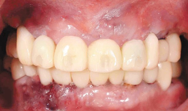 임플란트 식립 당일 임시 치아 장착사진.