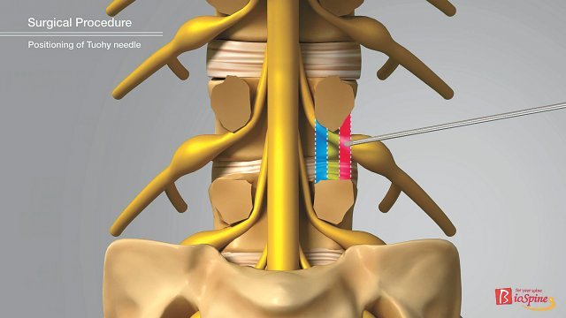 빨간색과 초록색으로 표시된 부위(추간공 내·외측)를 공략하면 해당 신경가지의 후근신경절의 압박을 줄여줄 수 있다. 파란색으로 
표시된 부위와 그 왼쪽(추간공의 내측과 척추관 후방부)을 공략하면 아랫마디로 분기되는 신경가지 출발점 부위 압박을 줄여줄 수있다.