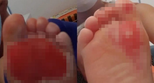 영국의 22개월 아기가 폭염으로 뜨거워진 주방 바닥에 발바닥 화상을 입었다. 페이스북 갈무리