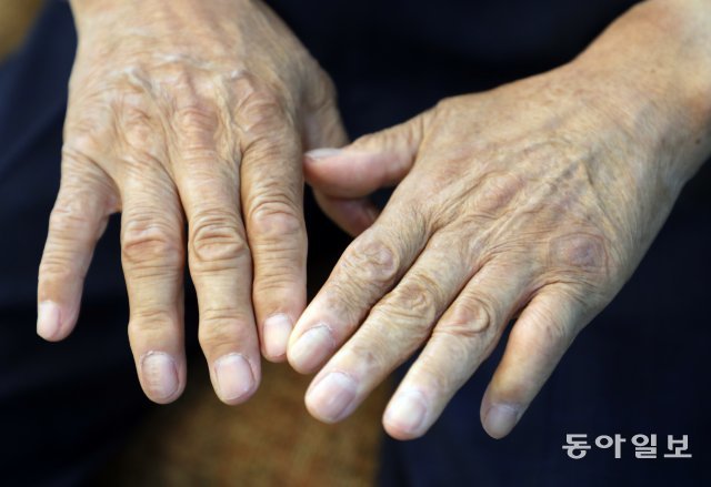 구자관 삼구아이앤씨 책임대표사원의 손. 36세에 공장이 전소해 불구덩이에 휩싸인 그의 손은 다른 부위를 이식 수술해 겨우 살려냈다. 78세 고령이지만 그는 오토바이를 타고 수상스키, 비행기 조종도 배웠다. 이훈구 기자 
ufo@donga.com