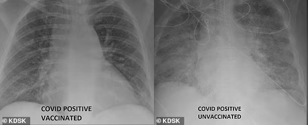 백신 접종한 코로나19 확진자의 폐(왼쪽)와 비접종 확진자의 폐(오른쪽)가 보인 엑스레이(X-Ray). 미국 방송국 KDSK