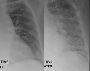 깨끗한 모습을 보인 백신 접종한 환자의 폐(왼쪽)에 비해 뿌옇게 나타난 비접종 환자(오른쪽)의 폐. 미국 방송국 KDSK