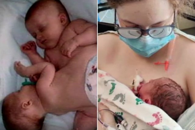 샴쌍둥이(왼쪽 사진)로 태어나 분리수술을 받은 채리티 링컨 구티에레스 바스케스가 12일(현지시각) 분리 수술을 받은 병원에서 딸 알로라(오른쪽 사진)를 출산했다. 사진출처=피플닷컴
