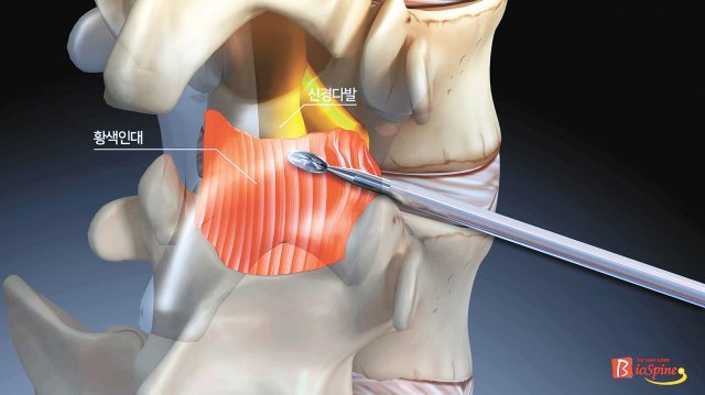 상대적으로 안전한 추간공의 ‘등쪽 경막외강’을 타깃으로 하는 추간공접근법을 나타내는 모식도. 특수 키트를 척추관의 중앙부(mid-line) 근방까지 접근시키고 황색 인대를 광범위하게 절제할 수 있다. 서울광혜병원 제공